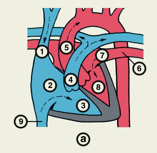Рис. 23а). Схематическое изображение отдельных врожденных пороков сердца (направления кровотока обозначены пунктирными стрелками, локализация пороков — сплошными стрелками): <a href=