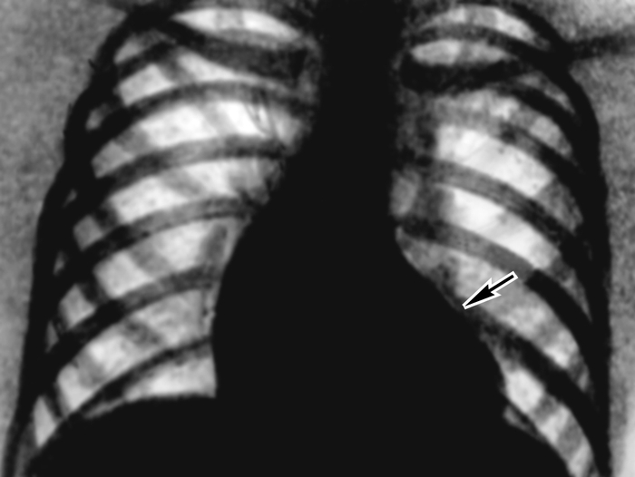Рис. 25. Рентгенограмма грудной клетки при аортальном стенозе: тень сердца имеет форму башмака (аортальная конфигурация) с увеличенным вследствие гипертрофии левым желудочком (указан стрелкой), верхушка закруглена