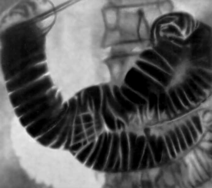 Рис. а). Рентгенограмма двенадцатиперстной кишки в условиях ее искусственной гипотонии: в норме (дано для сравнения)