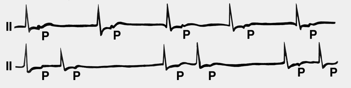 Рис. 9. Нижнеузловой ритм (верхняя ЭКГ), перешедший в реципрокный атриовентрикулярный ритм (нижняя ЭКГ) (по Л. И. Фогельсону). ЭКГ зарегистрированы во II отведении. На верхней кривой — правильный нижнеузловой ритм (за каждым желудочковым комплексом следует отрицательный зубец Р; частота импульсов 32 в 1 минуту). Кривой — спаренные желудочковые комплексы (так называемые сэндвичи)