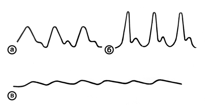 Рис. 5. Сфигмографическое отображение высокого скорого (б) и малого медленного (в) пульса в сравнении с нормальным пульсом (а)