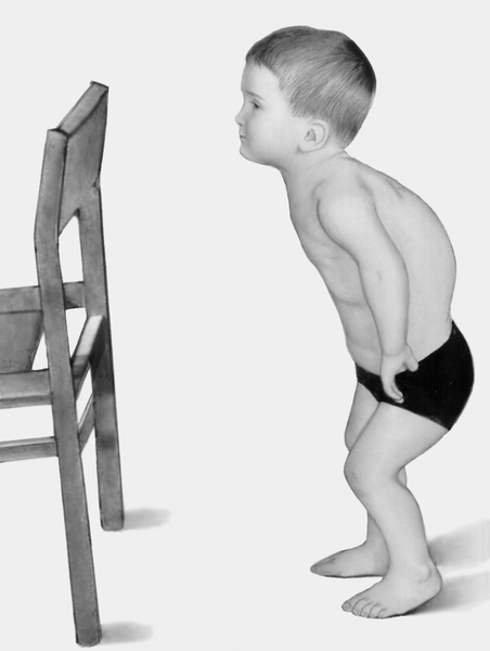 Рис. 8. Ребенок с метатропической дисплазией: голова отклонена кзади, туловище наклонено кпереди, сгибательные контрактуры в суставах, кифосколиоз