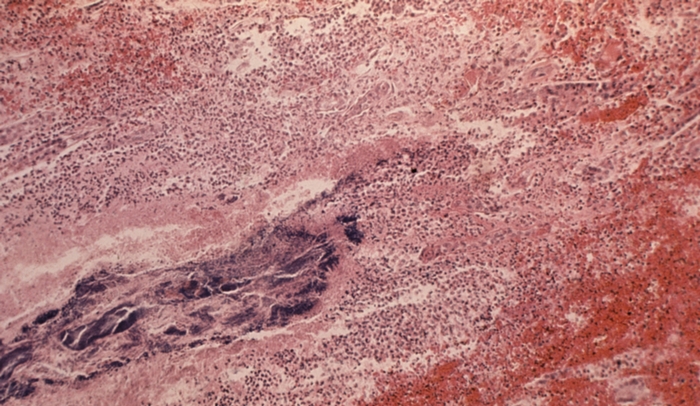 Рис. 3б). Микропрепарат почки при остром гнойном пиелонефрите: колонии микроорганизмов (синего цвета) в почечных канальцах; ×80
