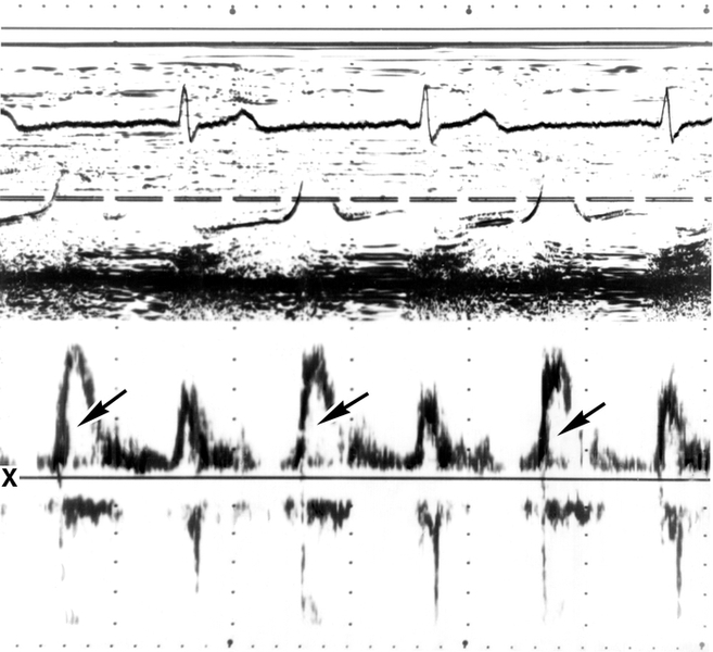 Рис. 5. Нормальная эхокардиограмма в М-режиме и допплер-эхокардиограмма — спектрограмма потока крови (внизу) в полости левого предсердия вблизи створок митрального клапана (локация со стороны левого желудочка). На спектрограмме представлен ламинарный (нормальный) поток через митральный клапан в диастолу. Сигналы имеют светлое 