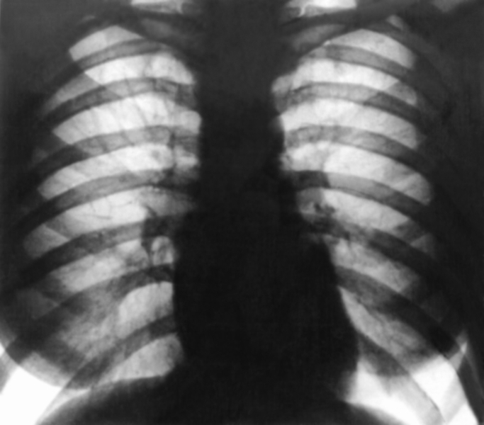Рис. 10а). Рентгенограмма грудной клетки больного с митральным стенозом (передняя проекция): выбухания третьей дуги по левому контуру тени сердца, поперечник сердечной тени мал