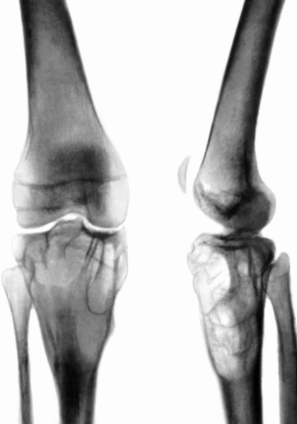 Рис. 3. Рентгенограммы области правого коленного сустава при аневризмальной кисте большеберцовой кости (центральная форма, фаза остеолиза) у <a href=
