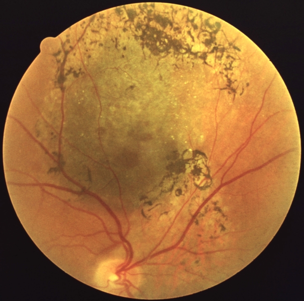 Рис. 9. Меланома собственно сосудистой оболочки: видны темно-серая проминирующая опухоль с оранжевыми полями в центральной части и пигментацией по периферии