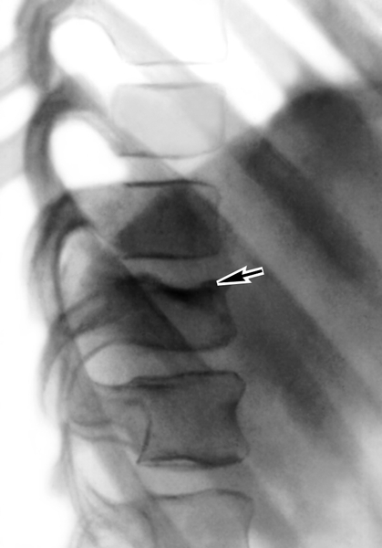 Рис. 5б). Рентгенограмма позвоночника при гематогенном гнойном спондилите (боковая проекция): ограниченное поражение по типу «дисцита» с субхондральной деструкцией XII грудного позвонка (указано стрелками)