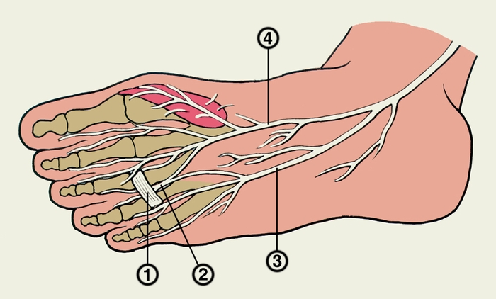 Рис. 2. Схематическое изображение механизма развития туннельного синдрома 4-го подошвенного пальцевого нерва: 1 — глубокая поперечная плюсневая связка III и IV пальцев; 2 — 4-й подошвенный пальцевый нерв; 3 — <a href=