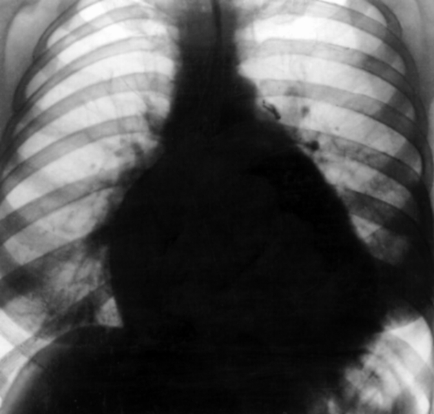 Рис. 5а). Рентгенограмма грудной клетки больной с хронической митральной недостаточностью (передняя проекция): тень сердца расширена в поперечнике в обе стороны, справа выбухает дуга левого предсердия, легочный ствол почти не выбухает