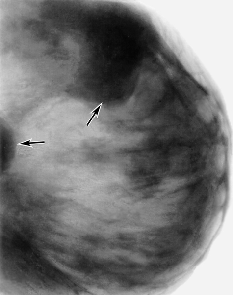 Рис. б). Маммограмма при мастопатии — определяются тени крупных кистовидных образований (указаны стрелками)