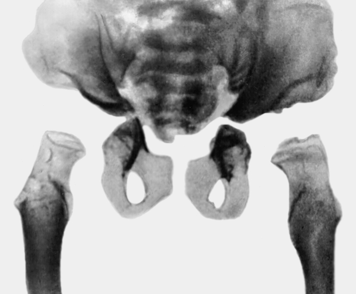 Рис. 6б). Рентгенологические признаки синдрома Моркио — деформация костей таза, вертлужных впадин, гипоплазия головок бедренных костей