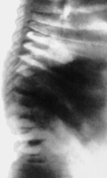 Рис. 6а). Рентгенологические признаки синдрома Моркио — искривление позвоночника и платиспондилия