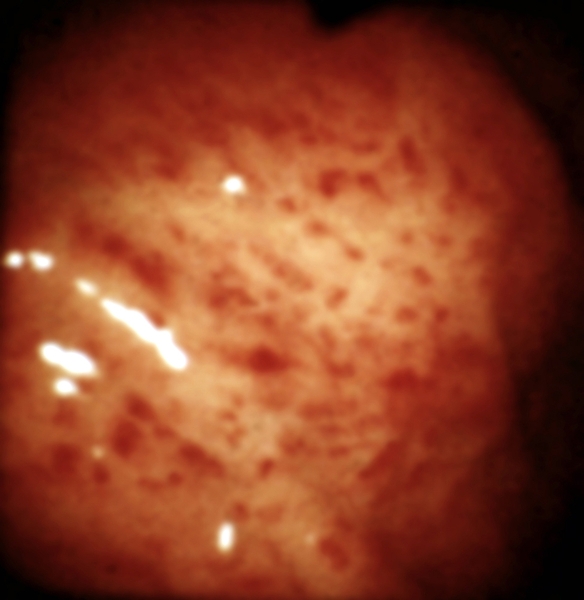 Рис. 3. Эндоскопическая картина желудка в норме и при различных заболеваниях. Поверхностный гастрит: слизистая оболочка желудка отечна, с мелкоточечными очагами гиперемии