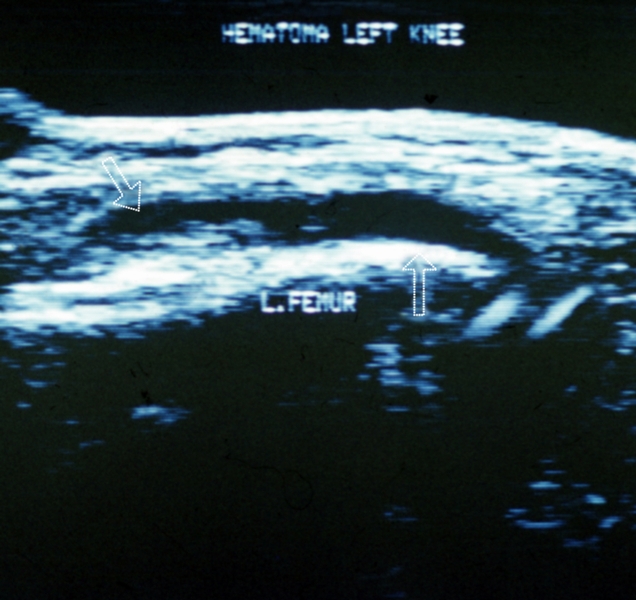 Рис. 25. Ультрасонограмма левого коленного сустава (продольный медиальный парапателлярный срез) при гемартрозе: стрелка слева указывает на скопление жидкости, стрелка справа на параоссальную гиперэхогенную структуру
