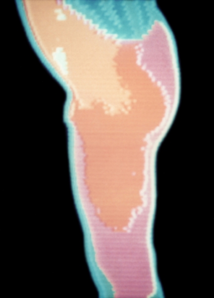 Рис. 15в). Термограмма ягодичной области при болезни Пертеса в начальной стадии (боковая проекция): увеличена теплопродукция области левого тазобедренного сустава