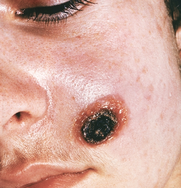 Рис. 1. Сибиреязвенный карбункул на лице: на фоне отека подкожной клетчатки в центре карбункула <a href=