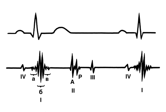 Схематическое изображение синхронно зарегистрированных фонокардиограммы (внизу) и электрокардиограммы (вверху) в норме: I, II, III, IV — соответствующие <a href=