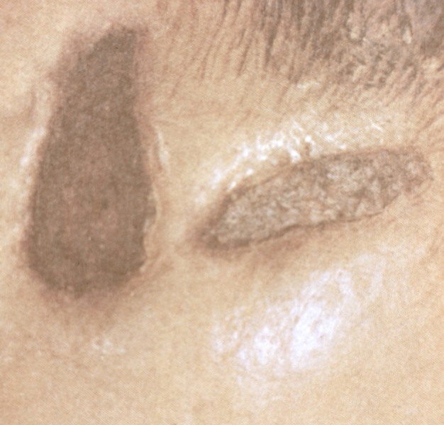 Рис. 2. Электроожог IV степени на коже головы: видны два участка сухого некроза (серо-черного цвета), окруженные отечными и инфильтрированными тканями (поражение электрическим током напряжением 660 В)