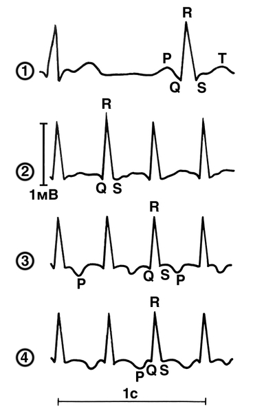 Рис. 1. ЭКГ во втором стандартном отведении при синусовом ритме (1) и разных видах суправентрикулярной пароксизмальной тахикардии: 2 — среднеузловая атриовентрикулярная тахикардия (зубец Р, слитный с комплексом QRS, не различим, комплекс QRS не уширен); 3 — нижнеузловая атриовентрикулярная тахикардия (отрицательный зубец Р следует за комплексом QRS, имеющим обычную ширину и форму); 4 — верхнеузловая атриовентрикулярная тахикардия (отрицательный зубец Р предшествует неизмененному комплексу ORS)