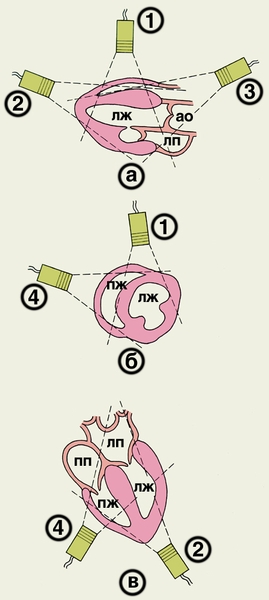 Рис. 1. Схема основных доступов для ультразвукового исследования сердца в сечении длинной оси (а), короткой оси (б) и с обозрением четырех камер сердца (в): 1 — парастернальная позиция датчика, место локации в III—IV межреберьях слева от грудины; 2 — верхушечная позиция, место локации в IV—V межреберьях по левой среднеключичной линии; 3 — супрастернальная позиция, локация со стороны яремной ямки; 4 — субкостальная позиция, локация со стороны эпигастральной области. Исследуемые структуры сердца на этом и других рисунках к статье имеют обозначения: АО — аорта, ЛЖ — полость левого желудочка, ЛП — полость левого предсердия, ПЖ — полость правого желудочка, ПП — полость правого предсердия