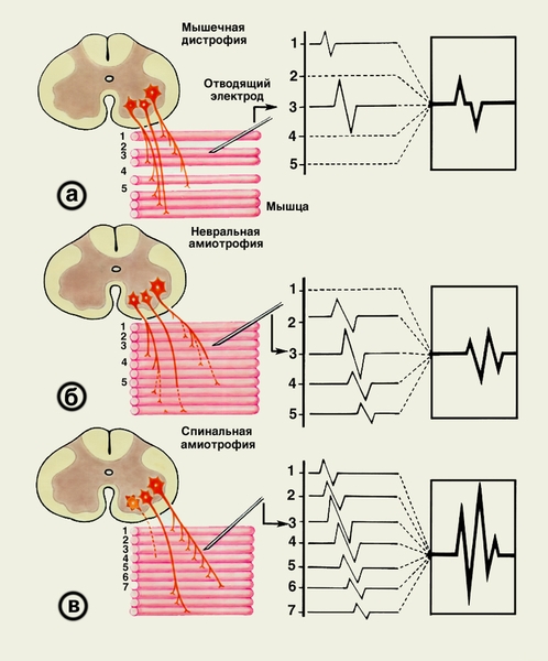 Рис. 1. Схема формирования локальных электромиограмм при первичном мышечном (а), невральном (б), спинальном (в) поражении двигательных единиц. А, Б, В — мотонейроны спинного мозга; 1—7 — мышечные волокна, относящиеся к иннервации мотонейронов