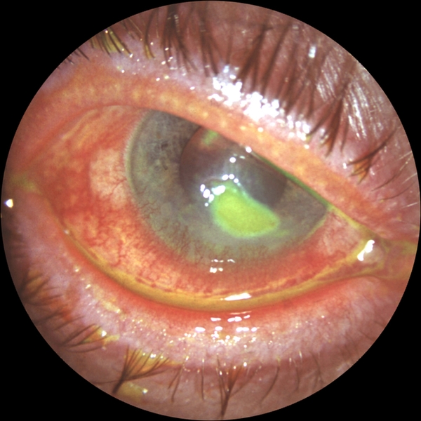 Рис. 3. Вид глаза при метагерпетическом кератите: определяется обширная глубокая язва роговицы (окрашена 1% раствором флюоресцеина)