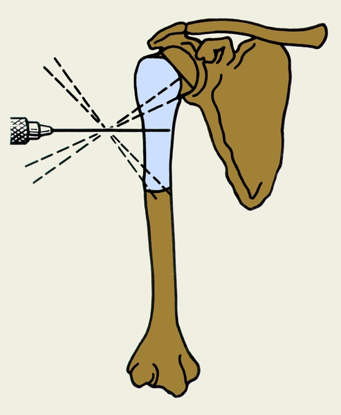 Рис. 5б). Схематическое изображение пункции кисты кости (а) и множественной перфорации ее стенки (б)