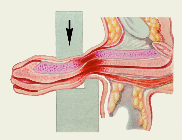 Рис. 4б). Наружные половые органы при травме полового члена без разрыва уретры: схематическое изображение механизма травмы
