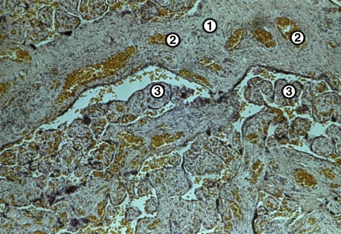 Рис. 3б). Микропрепарат участков плаценты с гемодинамическими нарушениями при доношенной беременности: полнокровие сосудов стромы стволовой ворсины (1 — стволовая ворсина, 2 — расширенные, заполненные кровью сосуды, 3 — концевые ворсины); окраска гематоксилином и эозином; ×65