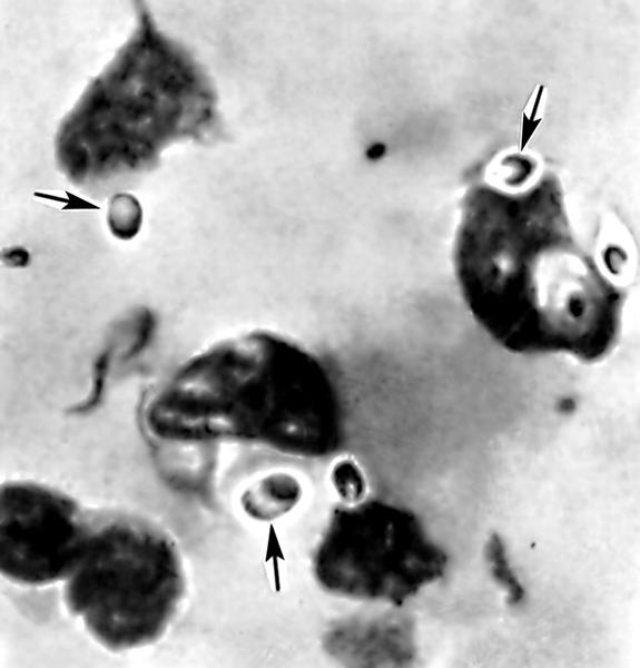 Рис. 2. Возбудитель гистоплазмоза — диморфный грибок в виде овальных дрожжевых клеток в гнойном отделяемом (указаны стрелками)