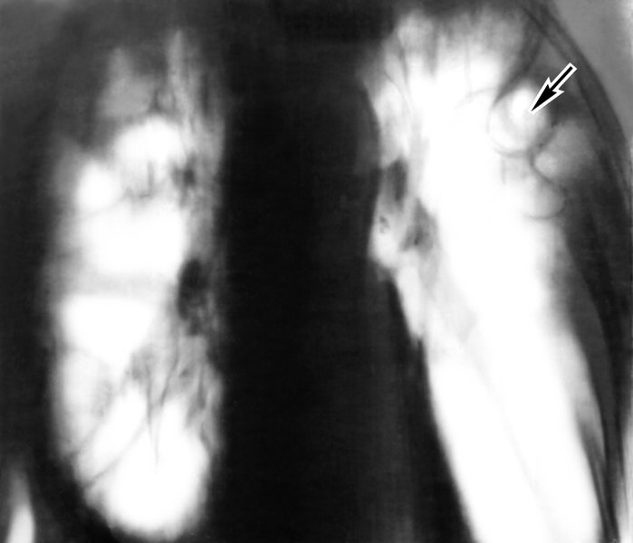 Рис. 1. Классическая рентгенотомограмма грудной клетки: в обоих легких видны тяжистые тени, свидетельствующие о пневмосклерозе; в верхней доле левого легкого определяется полость (указана стрелкой)