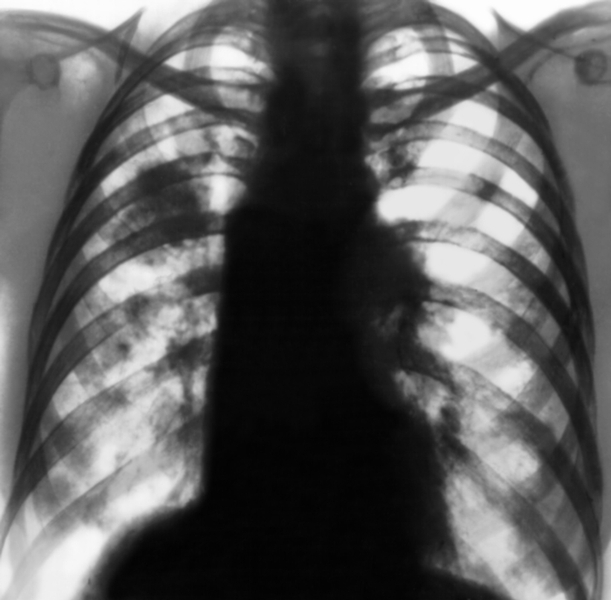 Рис. 12. Рентгенограмма органов грудной клетки в прямой проекции при интерстициально-очаговой пневмонии: на фоне усиленного и деформированого легочного рисунка в обоих легочных полях, преимущественно в правом, видны очаговые тени разных размеров