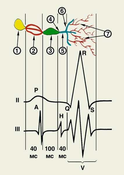 Рис. 3. Схема соотношения между элементами электрокардиограммы и внутрисердечной электрограммы (гисограммы). I — схематическое изображение проводящей системы сердца: 1 — синусовый <a href=