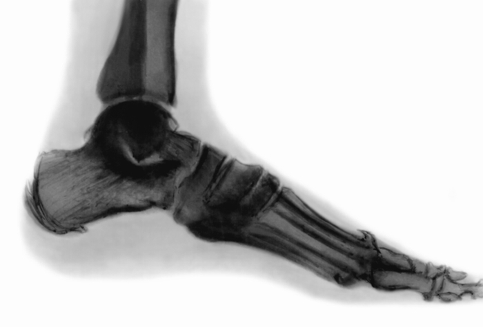 Рис. 1б). Рентгенограмма стопы (боковая проекция) больного с синдромом диабетической стопы: выражена остеоартропатия, поражены кости предплюсны