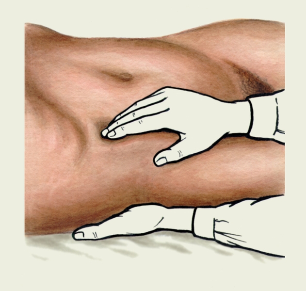 Рис. 5д). Положение рук исследующего при поверхностной ориентировочной пальпации правой почки
