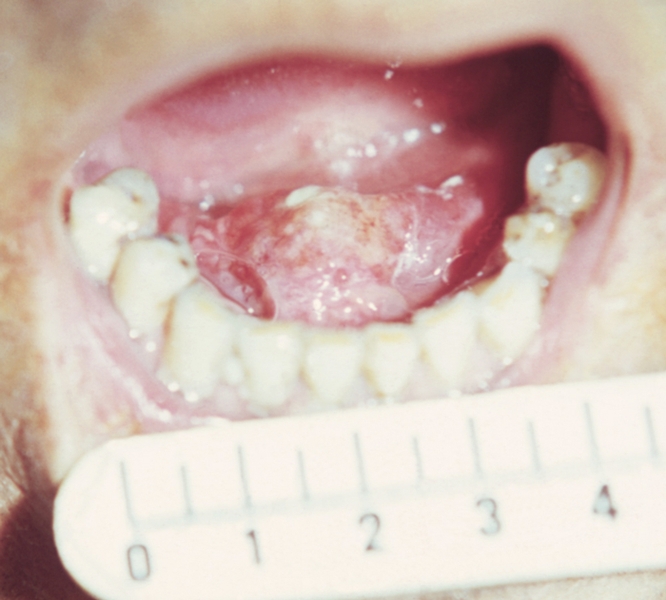 Рис. 5. Рак языка с переходом на дно полости рта