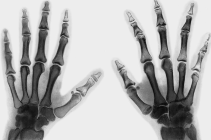 Рис. 32. Рентгенограмма кистей при трихоринофалангеальной дисплазии: отмечается вдавление дистального эпифиза в проксимальный эпифиз, наиболее резко выраженное на фалангах пальцев