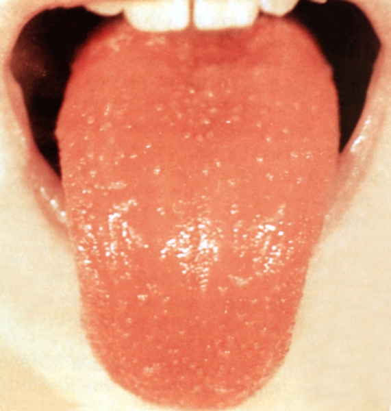 Рис. 2. Ярко-красный язык с выступающими сосочками («малиновый язык») у больного скарлатиной