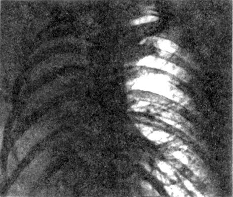 Рис. 1. Рентгенограмма грудной клетки (прямая проекция) при ателектазе правого легкого: правое легочное поле интенсивно затенено, органы средостения смещены вправо