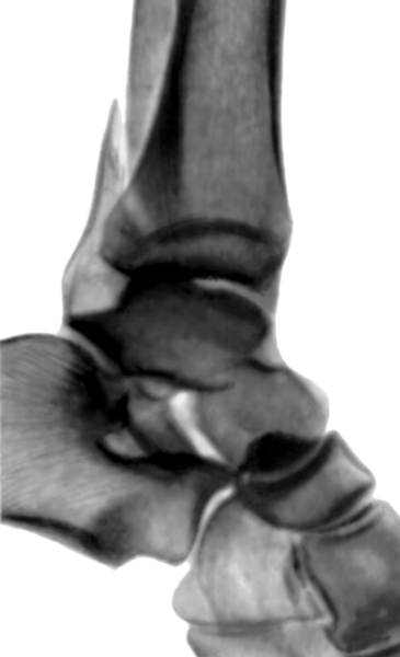 Рис. 4б). Рентгенограмма голеностопных суставов при переломах образующих их костей: перелом наружной лодыжки (боковая проекция)