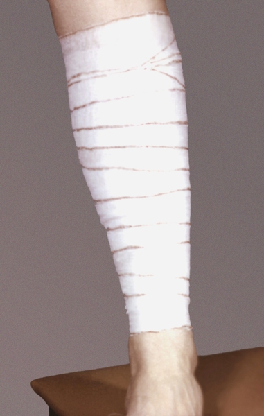 Рис. 3. Спиральная повязка на голень без перегибов бинта