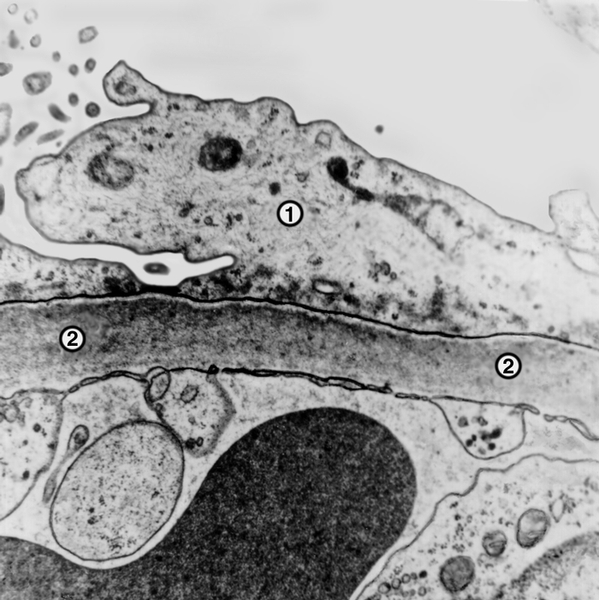 Рис. 5а). Электронограмма почки при липоидном нефрозе — слияние малых отростков подоцита (1) с образованием небольших выпячиваний клеточной мембраны, базальная мембрана (2) не изменена; ×15000