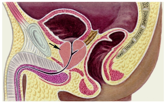 Рис. 1б). Схематическое изображение сагиттального разреза таза мужчины при аденоме предстательной железы: аденома предстательной железы (указана стрелкой) сдавливает простатическую часть мочеиспускательного канала