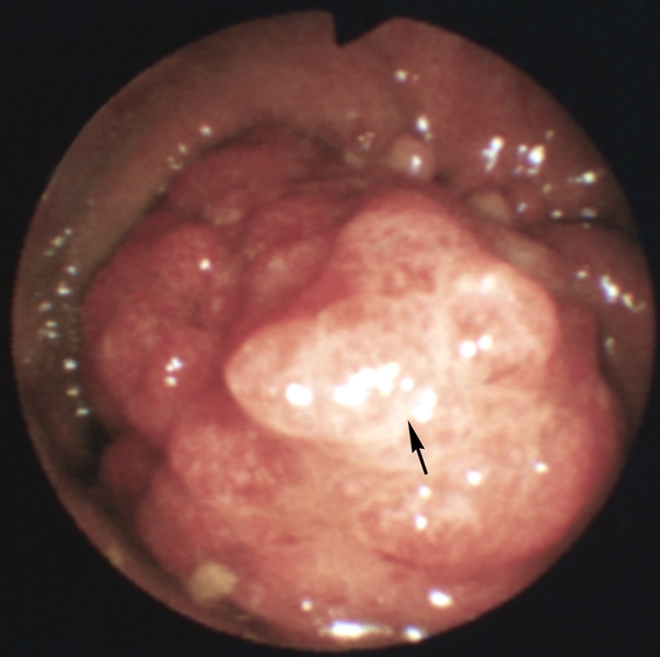 Рис. 3. Эндоскопическая картина толстой кишки в норме и при различных заболеваниях: ворсинчатая <a href=