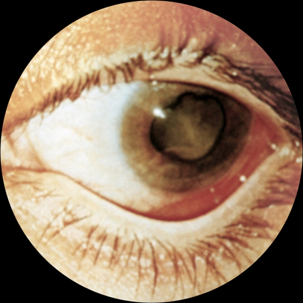 Рис. 3. Осложненная (постувеитная) катаракта: видны расширенный неправильной формы <a href=