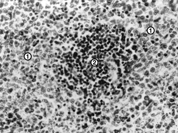 Рис. 3. Микропрепарат селезенки при остром монобластном лейкозе: лейкозная инфильтрация (1), резкое уменьшение размеров фолликулов (2). Окраска гематоксилином и эозином; ×280