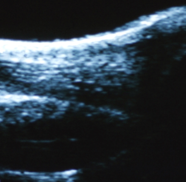 Рис. 8а). Ультрасонограмма пяточных сухожилий в норме: нормальная структура сухожилия