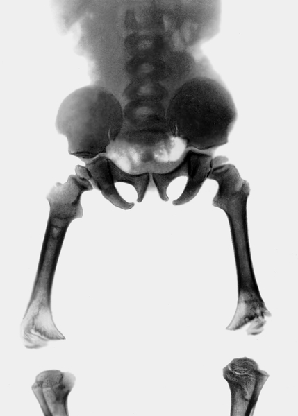 Рис. 2. Рентгенограмма тазобедренных и коленных суставов при ахондроплазии: крылья подвздошных костей имеют прямоугольную форму, таз расширен, большие вертелы бедренных костей массивны, эпифизы как бы погружены в метафизы, деформированы эпифизы костей, образующих коленные суставы