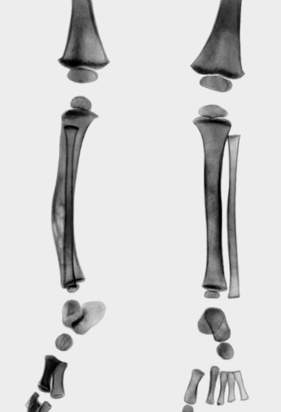 Рис. 41б). Рентгенограмма костей голени при младенческом кортикальном гиперостозе: исчезновение гомогенных периостальных наслоений через 6 месяцев